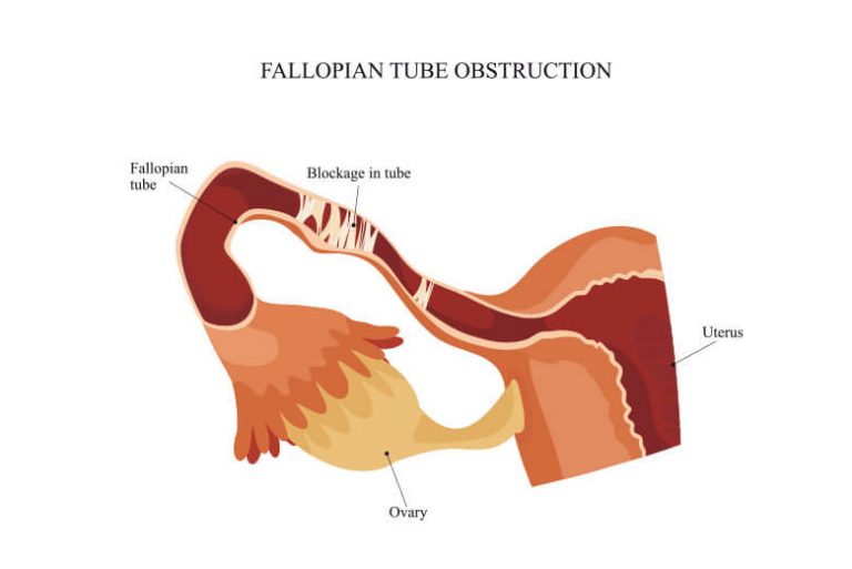 endometriosis ovulation bloating